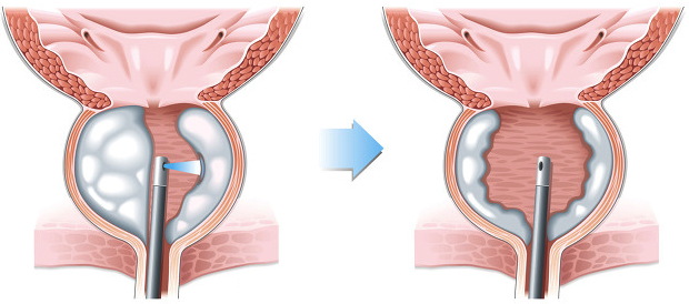 calcificazioni prostata onde d'urto
