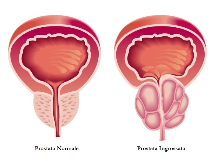 calcificazione prostata tumore