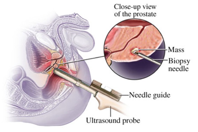 Biopsia prostatica transperineala - UROCLINIC - Clinica de Urologie Craiova